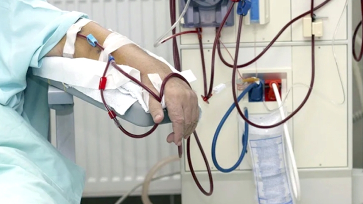 35 ألف مريض بالقصور الكلوي في الجزائر